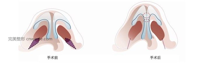 鼻尖整形方法的有哪些