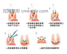 荆州鼻尖整形手术 让你的鼻子美到极致