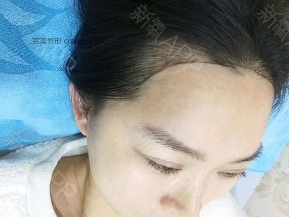 半永久纹发际线