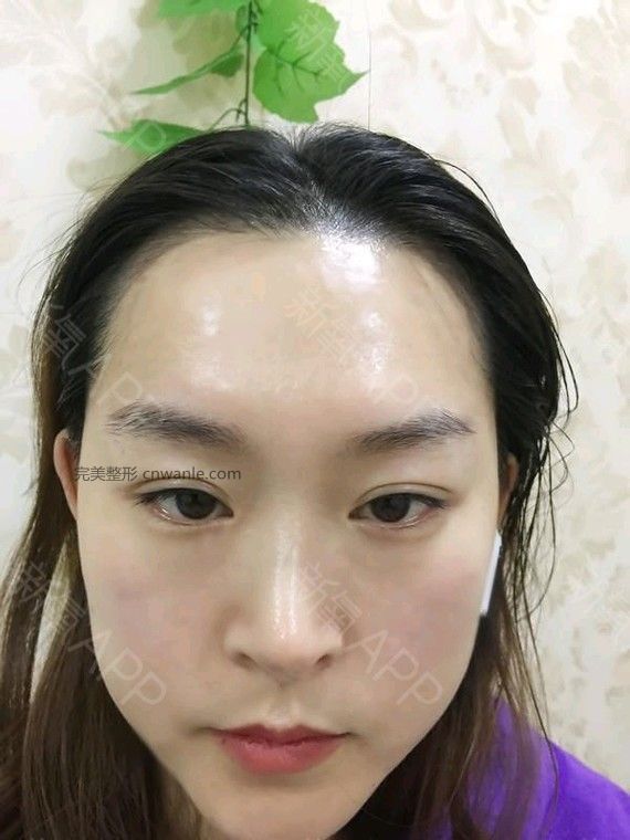 半永久纹发际线