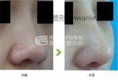做鼻尖整形手术的材料都有哪些?