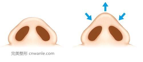 鼻尖整形方法的有哪些