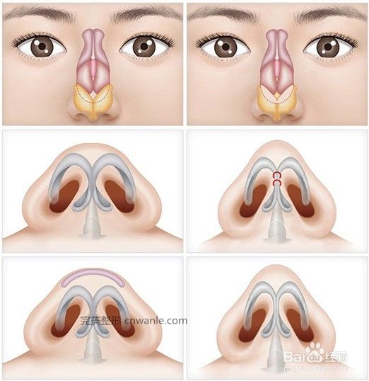鼻尖整形方法的有哪些