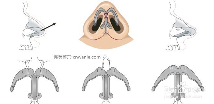 鼻尖整形方法的有哪些