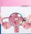 北京私密整形哪里好?—阴唇漂红