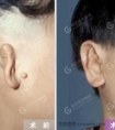 再造的耳朵怎么保养好?术后有哪些注意事项?