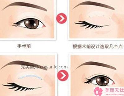 <a href='/tag_bijianzhengxingshu.html'>鼻尖整形术</a>5种鼻尖状况的矫正方法