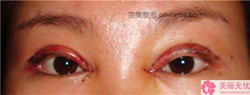 鼻尖整形术5种鼻尖状况的矫正方法