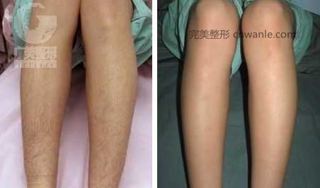 冰点脱毛的优势