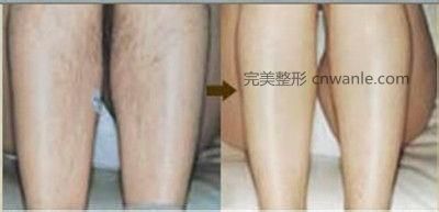 冰点脱毛几个月会长出来
