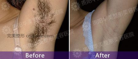 女神和女汉子，就差一次脱毛的距离！