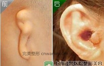 耳朵再造手术前后对比图