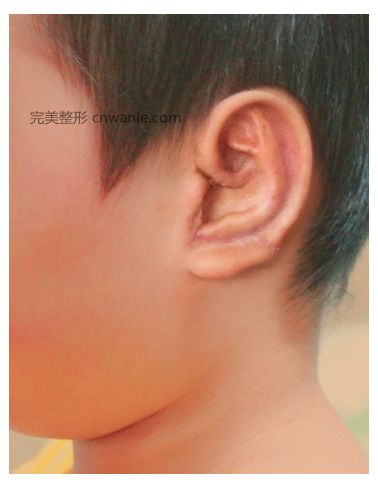 肋软骨耳再造二期手术