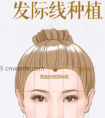 发际线种植和纹发际线哪种好呢