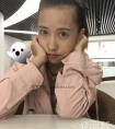 发际线种植效果好吗?案例分享