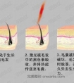 冰点脱毛是什么?冰点脱毛有什么优势