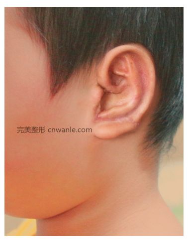肋软骨耳再造三期修复术