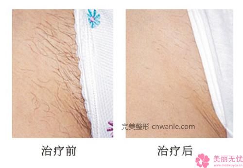 冰点脱毛有哪些优势_冰点脱毛的优点有哪些