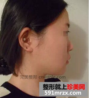 <a href='/tag_feishoushulongbi2.html'>非手术隆鼻</a>+鼻尖肥大整形 御姐范十足