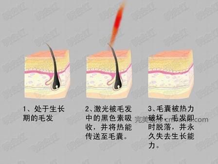 冰点脱毛