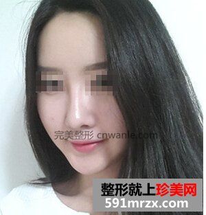 非手术隆鼻+鼻尖肥大整形 御姐范十足