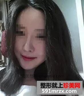 做了隆鼻和<a href='/tag_bijianzhengxing10.html'>鼻尖整形</a> 感觉鼻子很漂亮