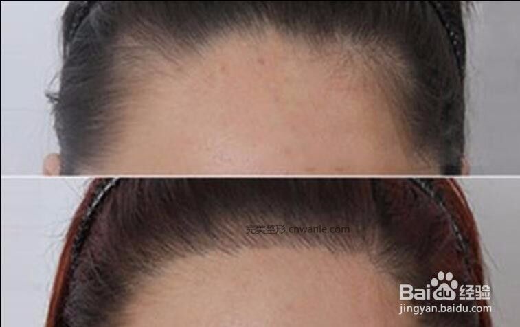 刚纹的发际线怎样去掉