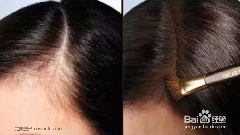 刚纹的发际线怎样去掉