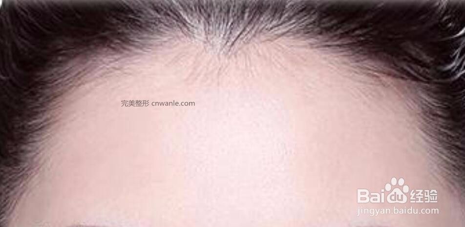 刚纹的发际线怎样去掉