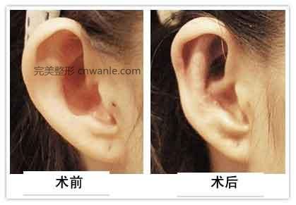 耳廓整形手术要注意什么