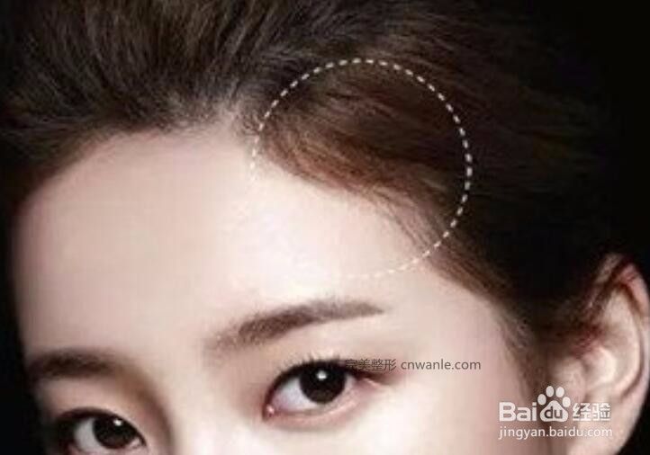 刚纹的发际线怎样去掉