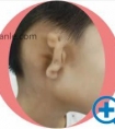 公开耳畸形男孩让郑大二附院整形科李钢做耳再造术后一期的照片