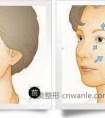 电波拉皮有哪些特色 电波拉皮能维持多久