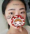 定点双眼皮+开眼角,术后恢复过程分享