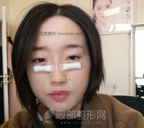 电波拉皮去眼袋效果太好了吧！这是什么神仙技术！