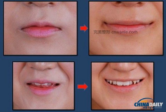 近几个月来，一种被称为“Smile Lipt”的嘴角<a href='/tag_zhengrong3.html'>整容</a>手术在韩国非常风靡。该手术将嘴角切开再缝合，重新调整上下颚的角度，使得嘴部的线条更柔和。