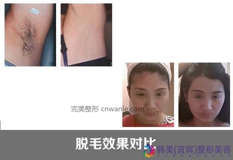 冰点脱毛的优势有哪些?冰点脱毛 冰点脱毛的优势有哪些?冰点脱毛