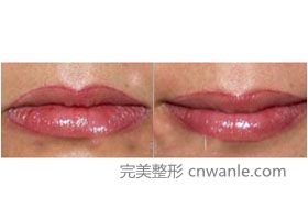 南昌邦林部口角成形手术案例