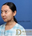 韩国女神医院做的嘴角上扬和M唇手术