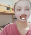 割双眼皮和开眼角,恢复大概需要多久?