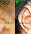 耳朵再造术后注意事项