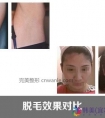 冰点脱毛的优势有哪些?冰点脱毛