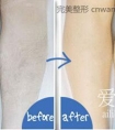 冰点脱毛的优势有哪些?_1