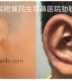耳廓再造常见问题解答 (2)