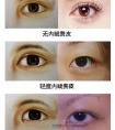 割双眼皮+开眼角,会越来越自然~