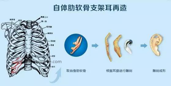 耳畸形_耳再造_肋软骨造耳_中整协耳再造救助修复基地