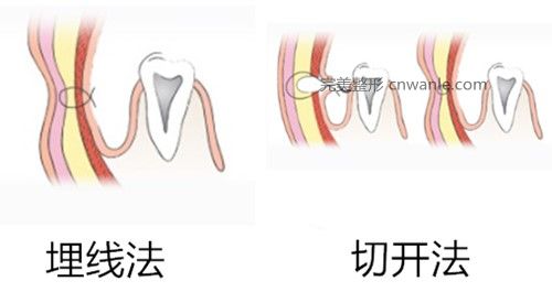 韩国酒窝成形术方法示意图