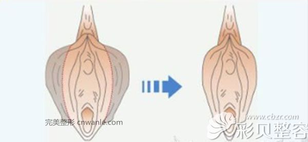 阴唇缩小效果对比图