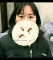 韩式开眼角手术恢复图|前后效果对比