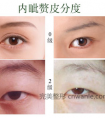 内眦赘皮,开眼角后能让眼睛变大吗